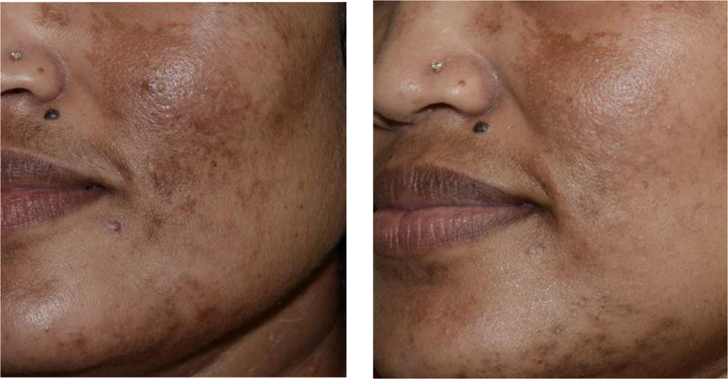 HarmonyXL Pro-Dye Mov. Rostro o Escote