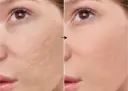 Madecasoside 1% de la marca Universkin: Resultados
