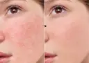 Niacinamide (Vitamina B3) 4% de la marca Universkin: Resultados
