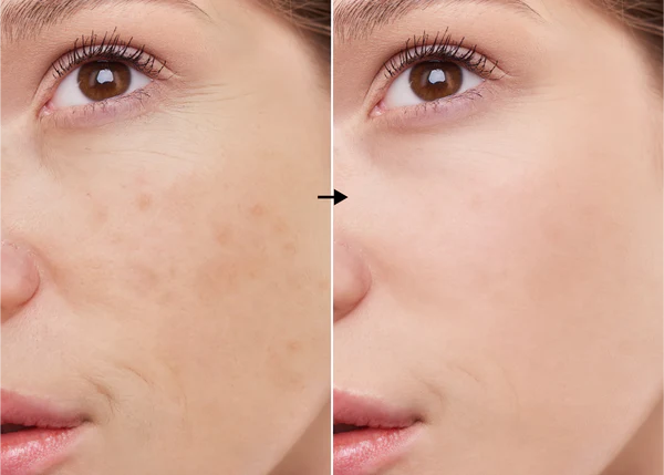 Retinol 0.2% de la marca Universkin: Resultados